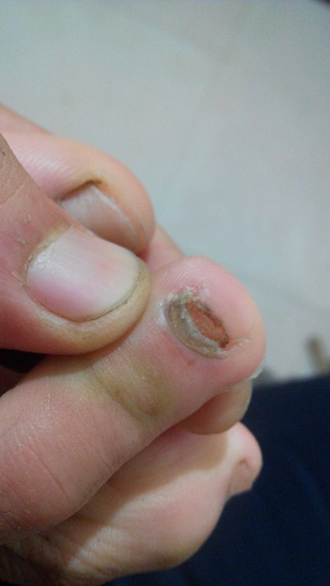 足球鞋磨大脚趾(足球鞋磨大脚趾是什么原因)